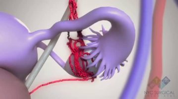Pelvic Pain Relief