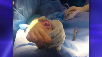 Cartiva: Toe Joint Replacement