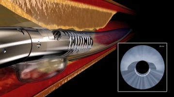 Revolutionary Catheter for PAD