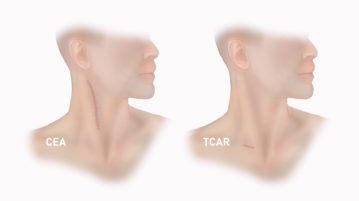 TCAR: Unclogging Carotid Arteries
