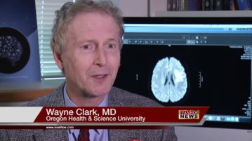 Stem Cells Extend Stroke Treatment Window