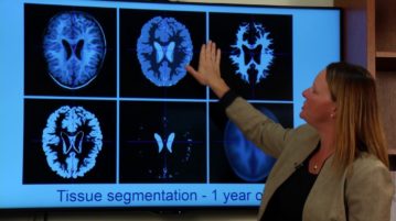 Infant Brains Show Autism Early