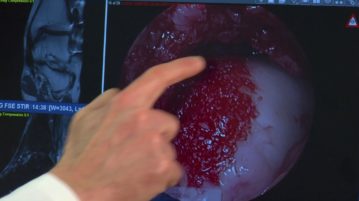 BioCartilage Patches Potholes in the Body