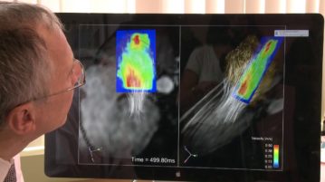 Treating Afib: 4D Blood Flow MRI