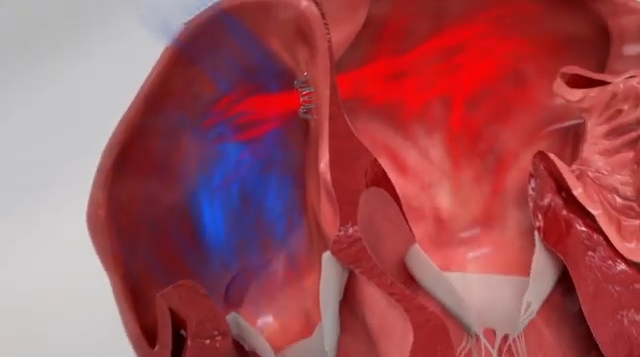 Diastolic Heart Failure: Trial Puts Novel Device to the Test