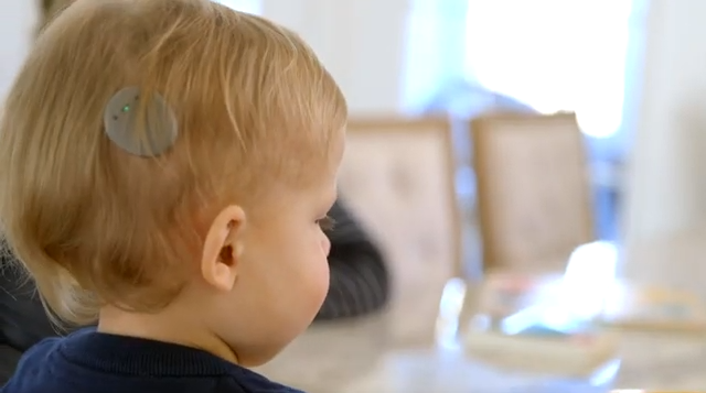 Cochlear Implant