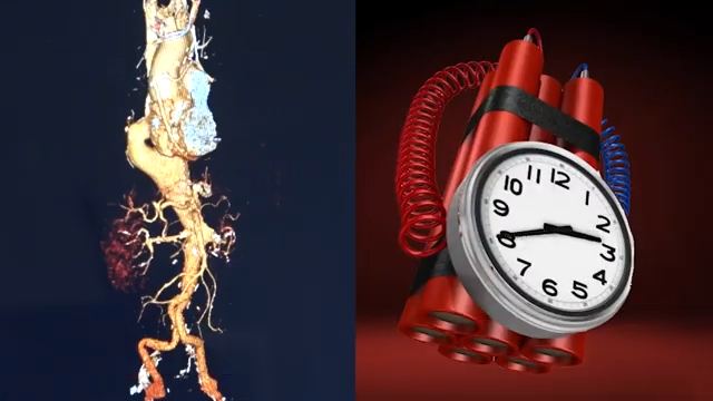 Aortic Aneurysm Warning Signs Silent Killer Ivanhoe Broadcast News Inc 
