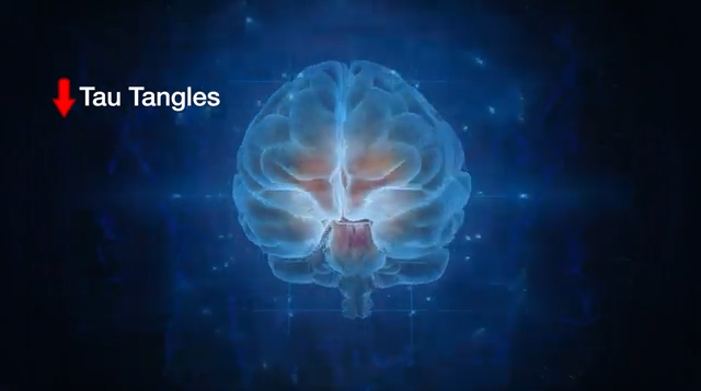 First FDA Approved Drug to Slow Alzheimer’s