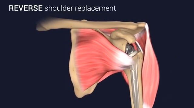 Reverse Shoulder Surgery: Rethinking Implants