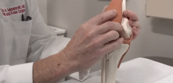 Reducing Knee Pain Without Surgery