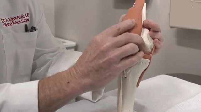 Reducing Knee Pain Without Surgery