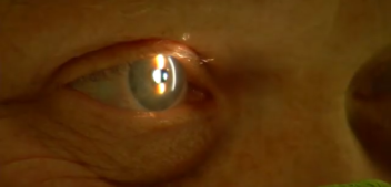 Breakthroughs For Dry Macular Degeneration Are on the Way