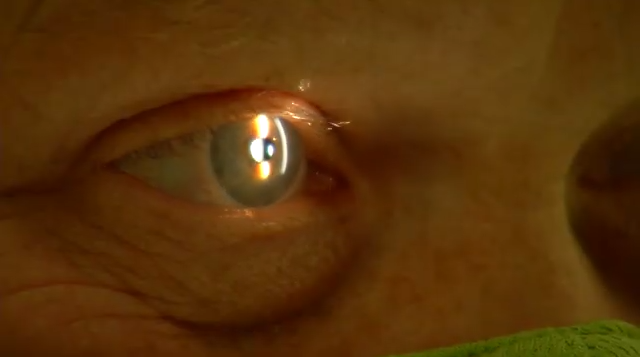 Breakthroughs For Dry Macular Degeneration Are on the Way