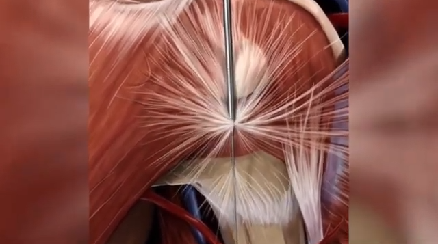 Dry Needling to Relieve Pain